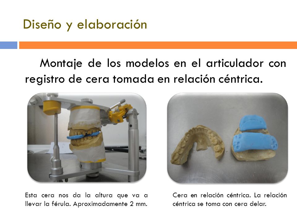 Diseño y elaboración Montaje de los modelos en el articulador con registro de cera tomada en relación céntrica.
