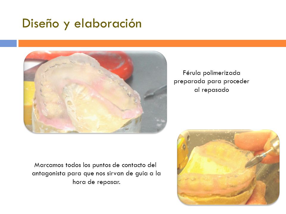 Diseño y elaboración Férula polimerizada preparada para proceder al repasado. Marcamos todos los puntos de contacto del.