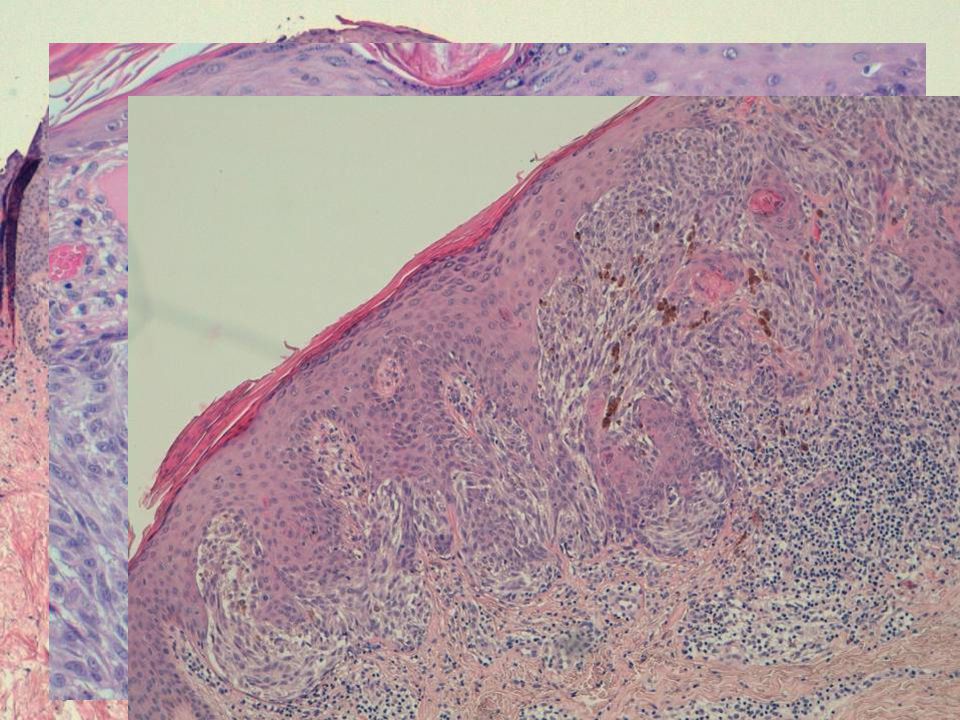 Al examen microscópico se comprobó que ambas coincidían en cuanto a sus características histopatológicas: