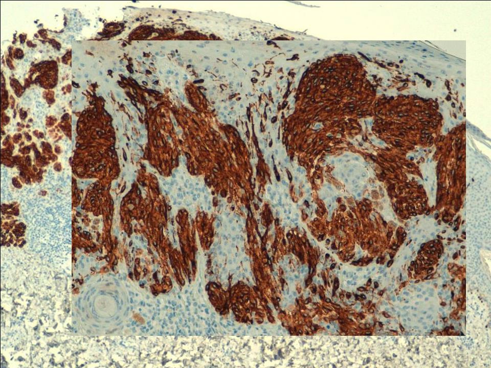 En la inmunohistoquímica el melan-a demostró una tinción intensa de dichas células melanocíticas poniendo de relieve la distribución en forma de tecas predominantemente en la unión, pero también con componente dérmico en pequeños acúmulos…