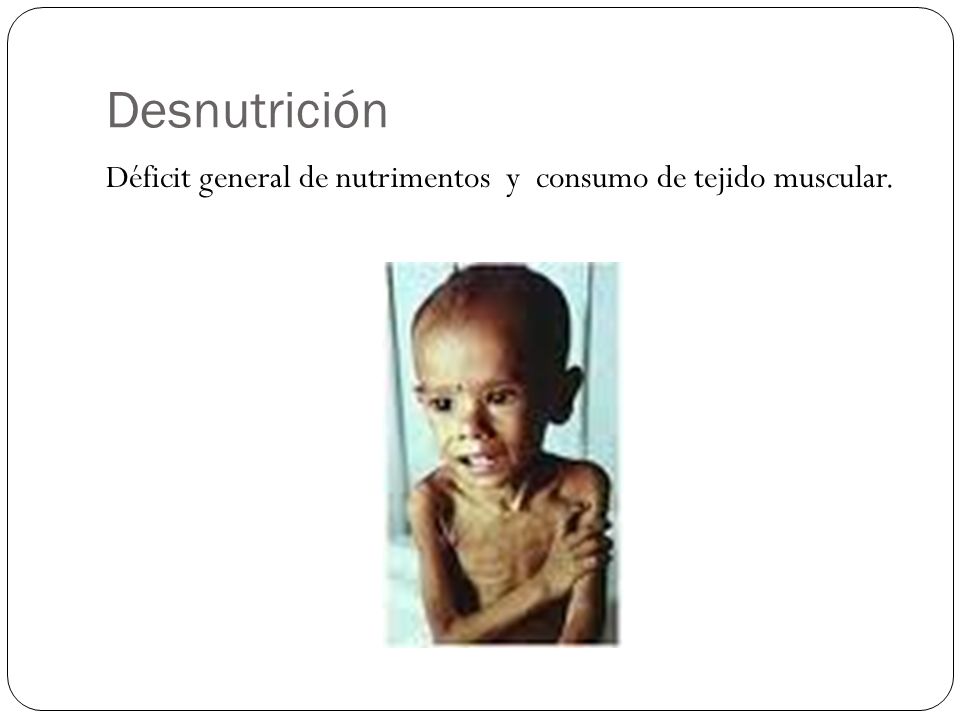 Desnutrición Déficit general de nutrimentos y consumo de tejido muscular.
