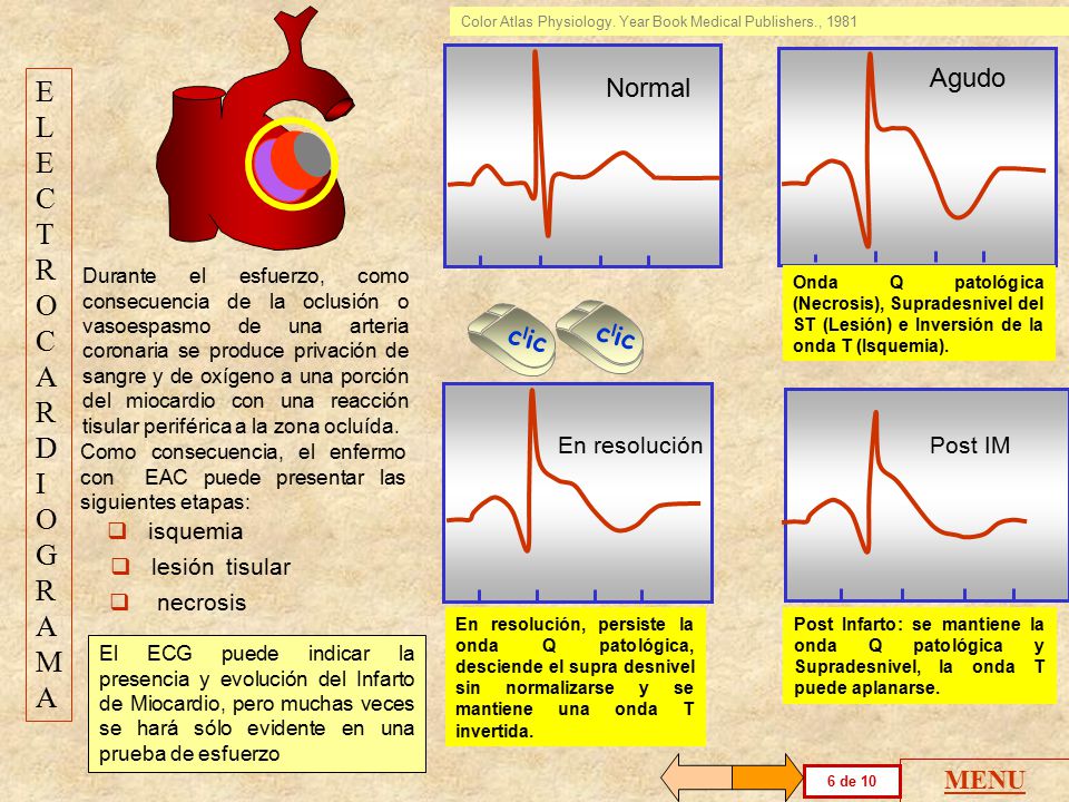 ELECTROCARDIOGRAMA Agudo Normal clic clic MENU En resolución Post IM
