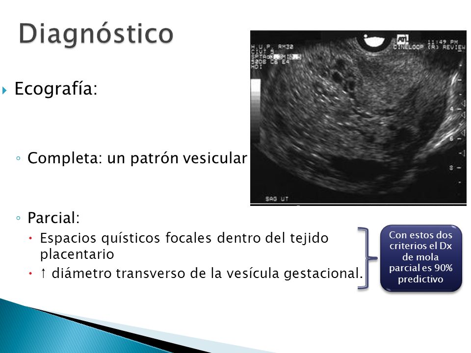 Con estos dos criterios el Dx de mola parcial es 90% predictivo