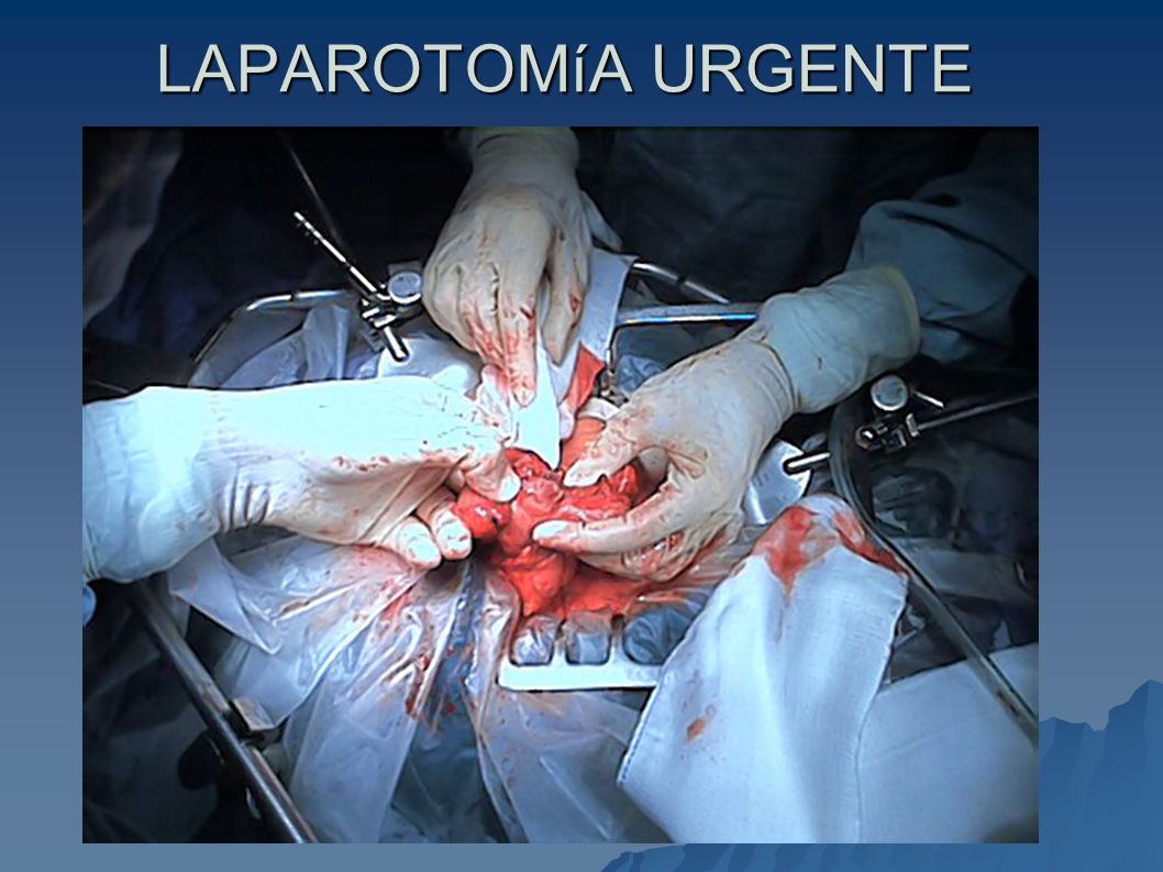 LAPAROTOMíA URGENTE