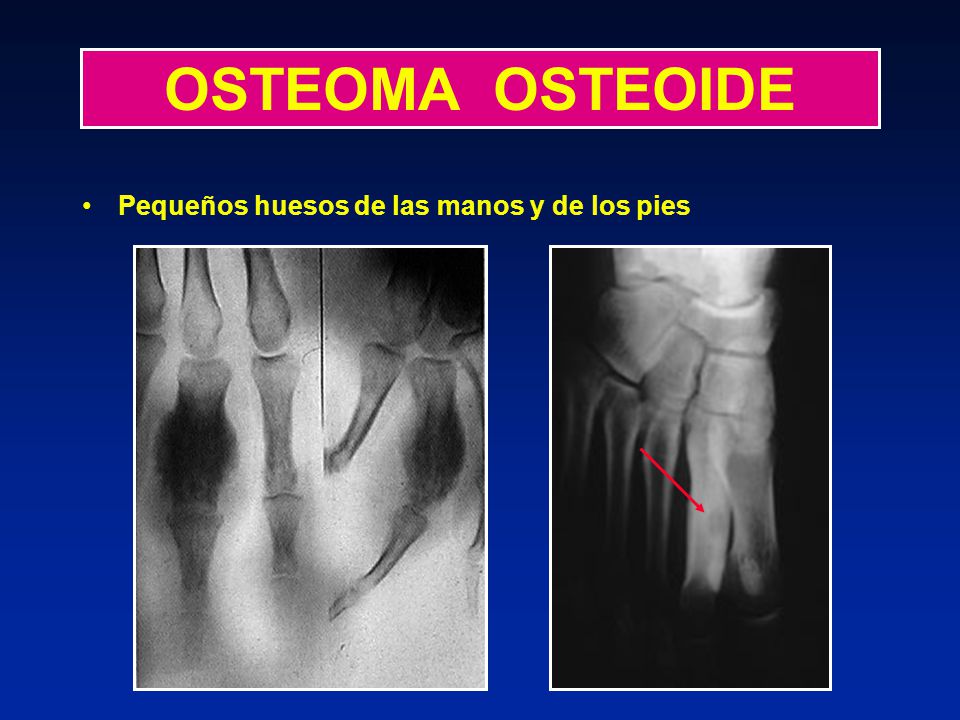 OSTEOMA OSTEOIDE Pequeños huesos de las manos y de los pies