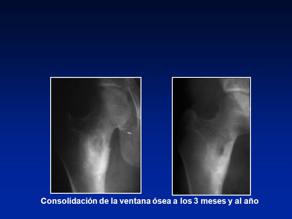 Consolidación de la ventana ósea a los 3 meses y al año