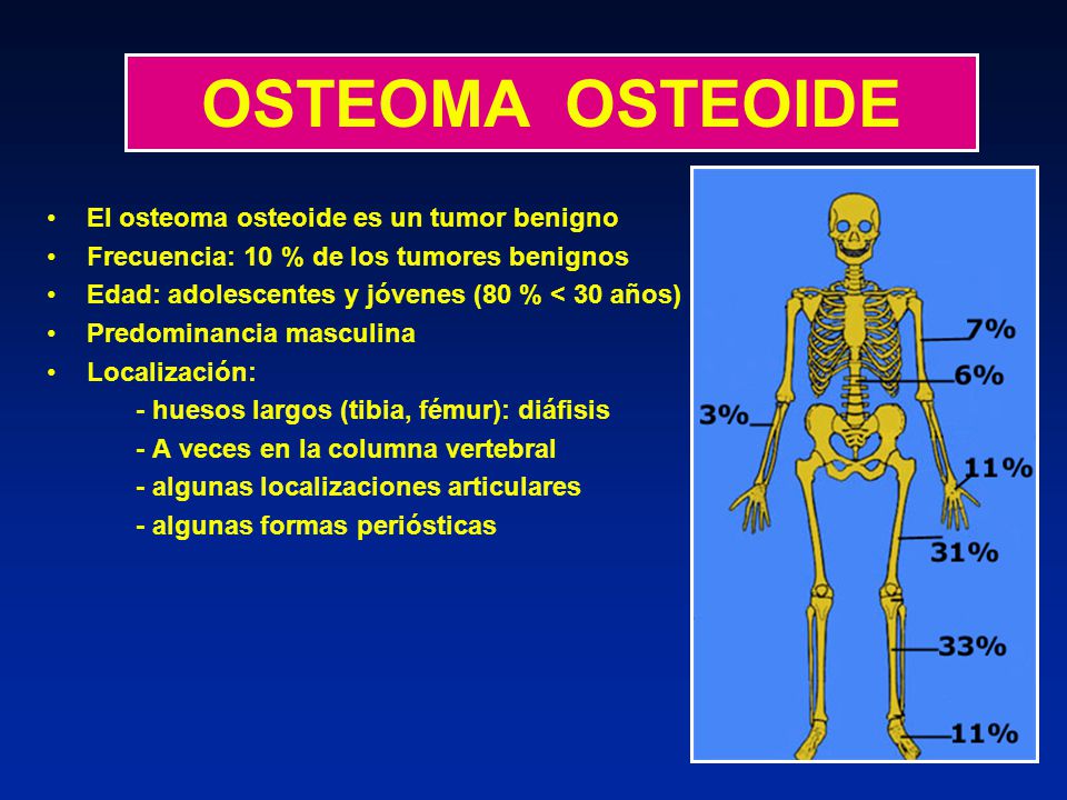 OSTEOMA OSTEOIDE El osteoma osteoide es un tumor benigno