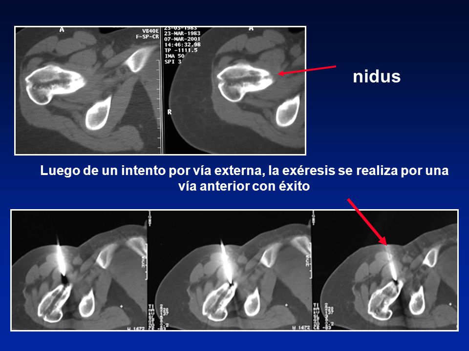 nidus Luego de un intento por vía externa, la exéresis se realiza por una vía anterior con éxito