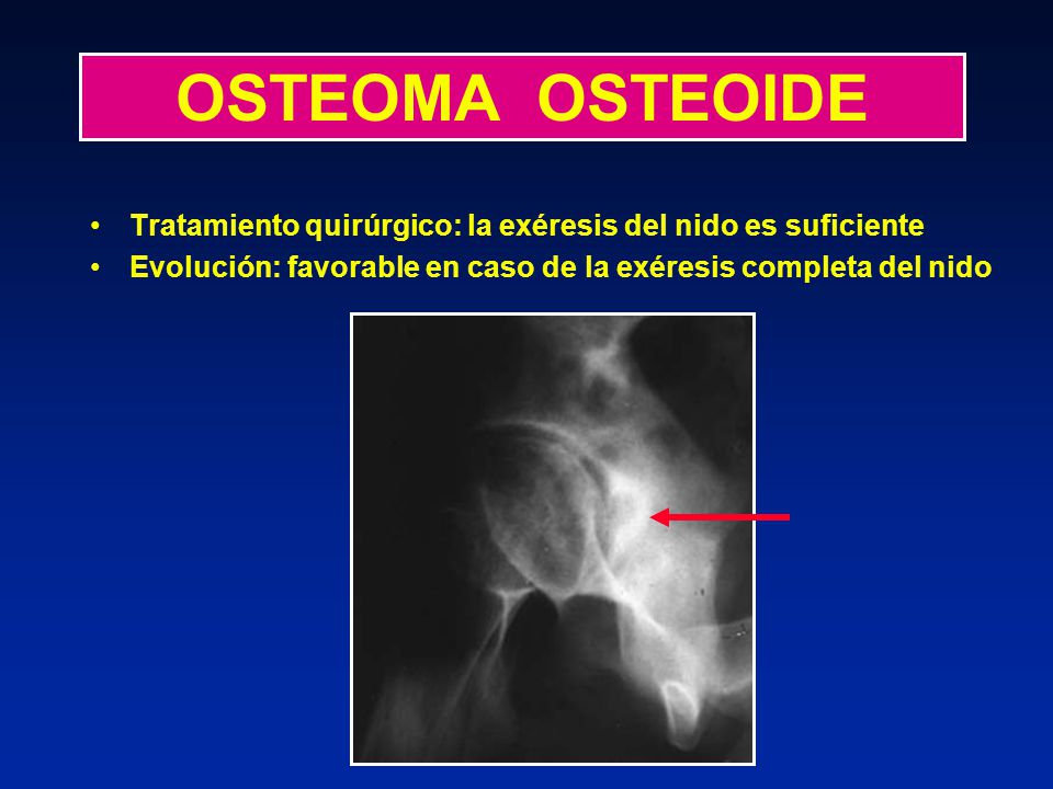 OSTEOMA OSTEOIDE Tratamiento quirúrgico: la exéresis del nido es suficiente.
