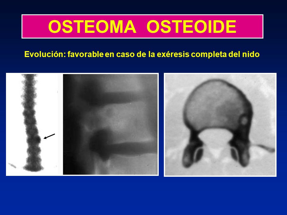 OSTEOMA OSTEOIDE Evolución: favorable en caso de la exéresis completa del nido