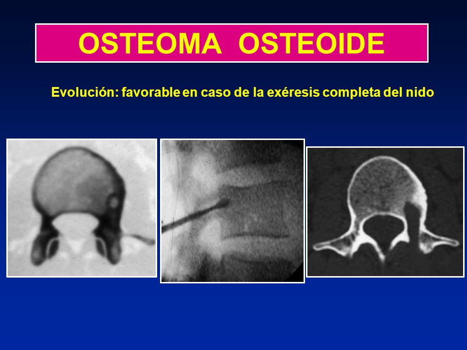 OSTEOMA OSTEOIDE Evolución: favorable en caso de la exéresis completa del nido