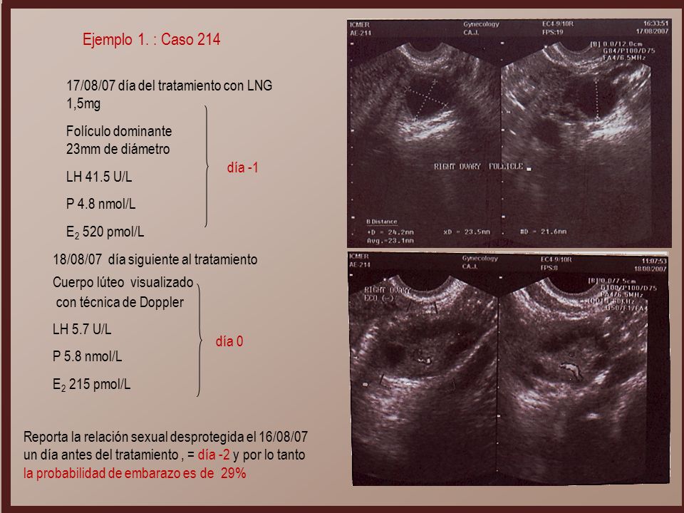 Ejemplo 1. : Caso /08/07 día del tratamiento con LNG 1,5mg