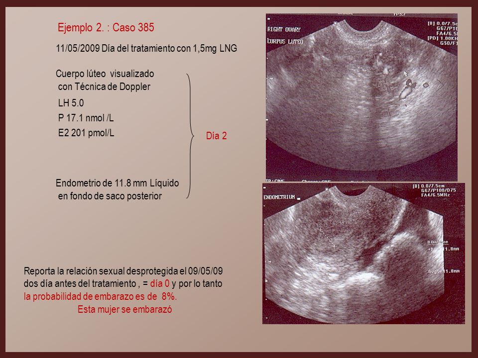 Ejemplo 2. : Caso /05/2009 Día del tratamiento con 1,5mg LNG