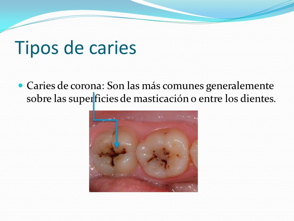 Tipos de caries Caries de corona: Son las más comunes generalemente sobre las superficies de masticación o entre los dientes.