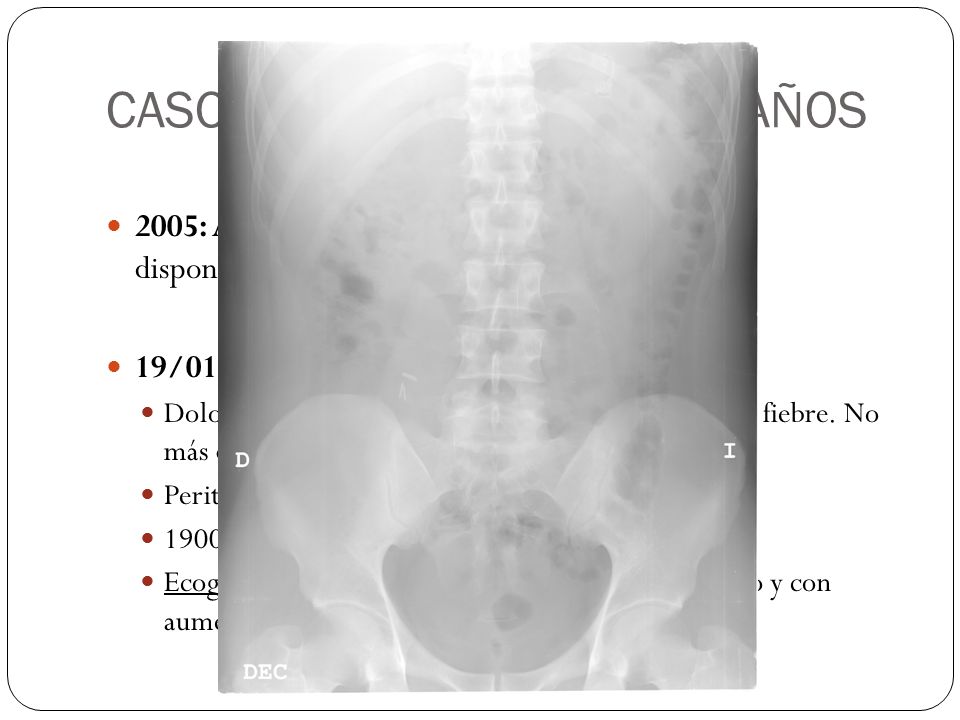 CASO 2: EM.F.G. VARÓN 29 AÑOS 2005: Apendicectomía LPS en otro centro (no disponemos de datos). 19/01/2007: Urgencias (2 años después)