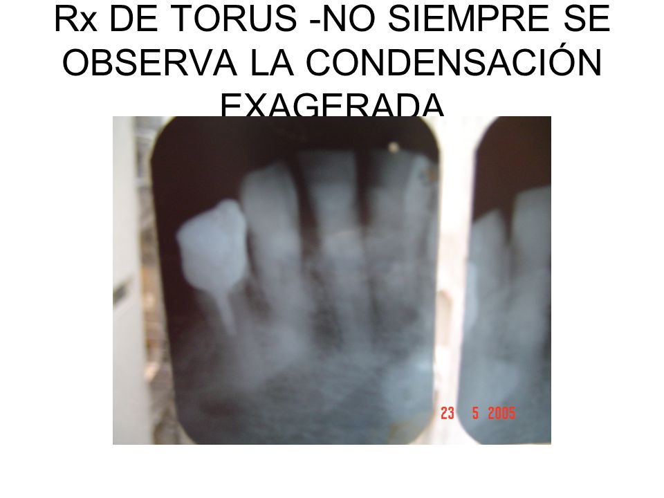 Rx DE TORUS -NO SIEMPRE SE OBSERVA LA CONDENSACIÓN EXAGERADA