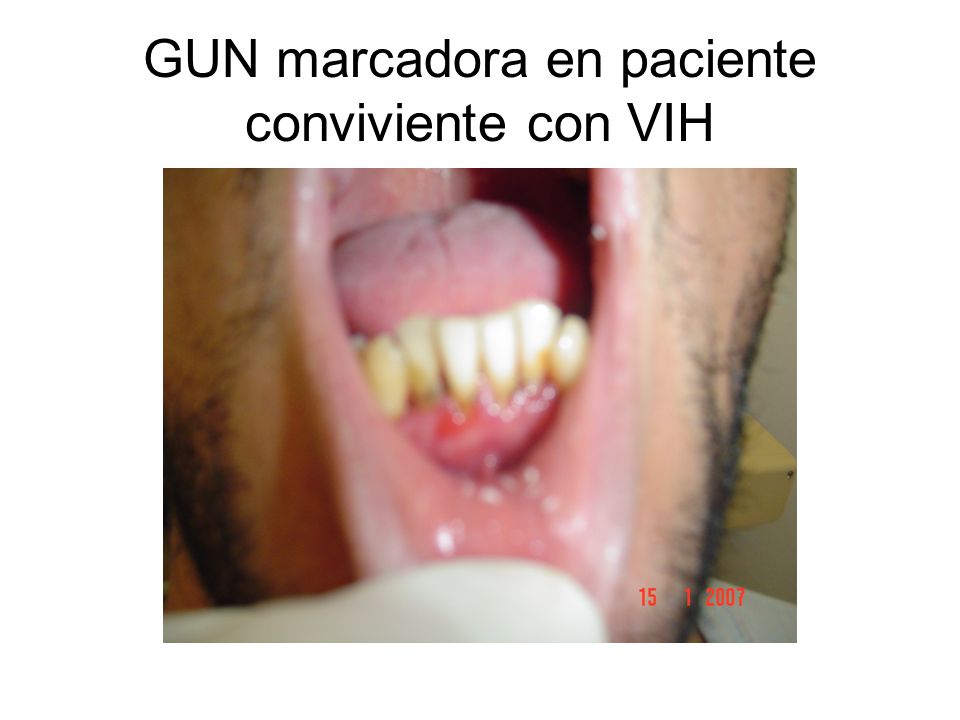GUN marcadora en paciente conviviente con VIH