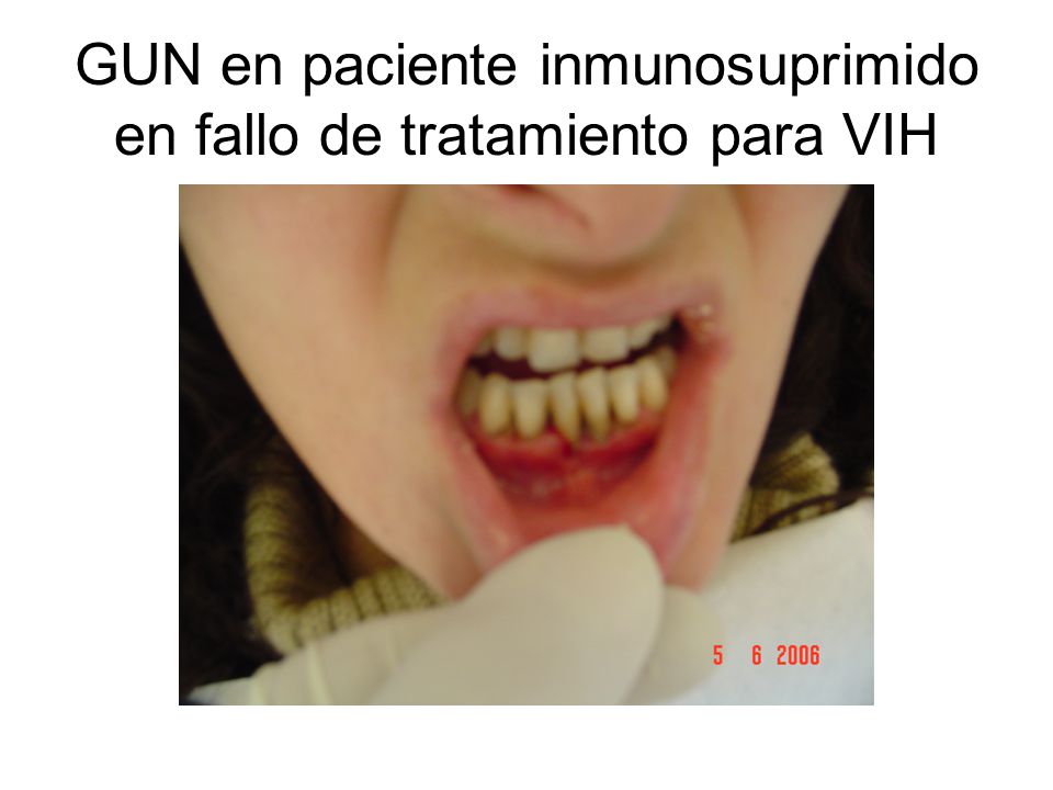 GUN en paciente inmunosuprimido en fallo de tratamiento para VIH