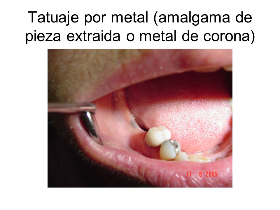 Tatuaje por metal (amalgama de pieza extraida o metal de corona)