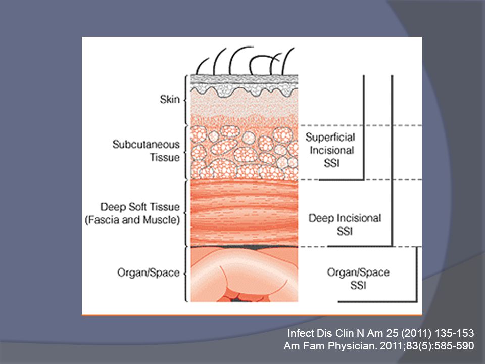 Infect Dis Clin N Am 25 (2011) Am Fam Physician. 2011;83(5):