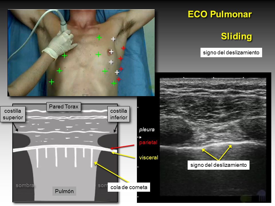 ECO Pulmonar Sliding + + signo del deslizamiento costilla inferior