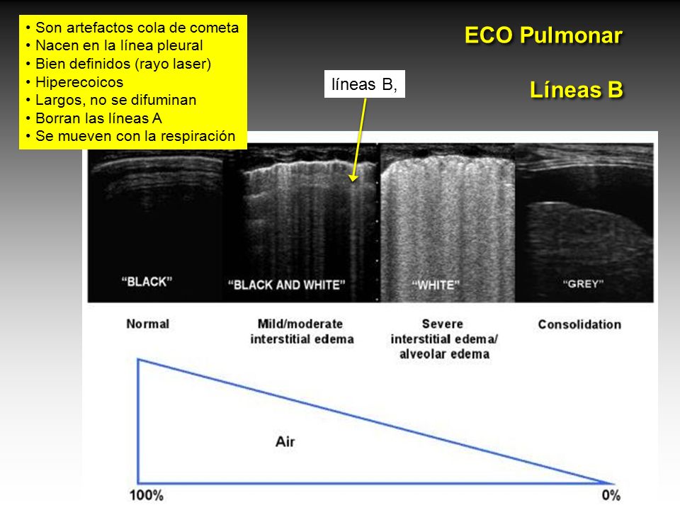 ECO Pulmonar Líneas B líneas B, Son artefactos cola de cometa