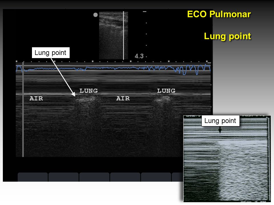 ECO Pulmonar Lung point Lung point Lung point Lung Point