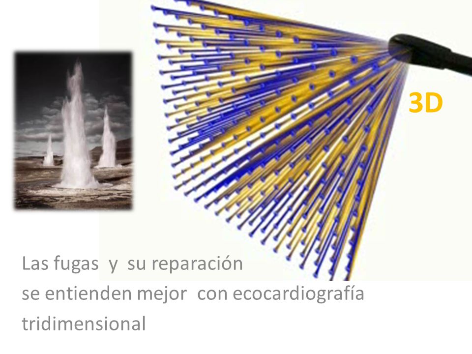 3D Las fugas y su reparación se entienden mejor con ecocardiografía