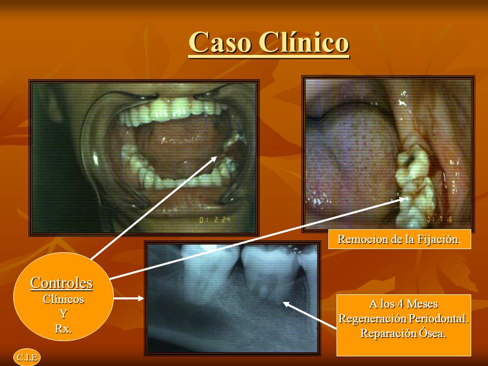 Caso Clínico Controles Remocion de la Fijación. Clínicos Y Rx.