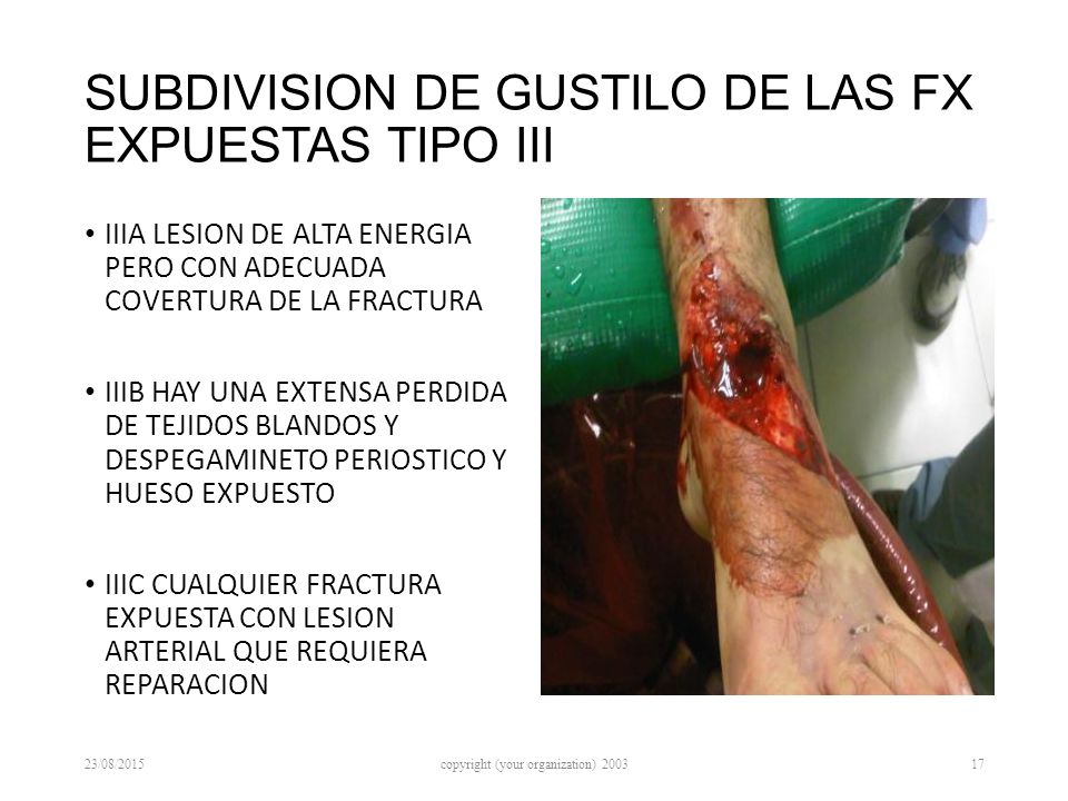 SUBDIVISION DE GUSTILO DE LAS FX EXPUESTAS TIPO III