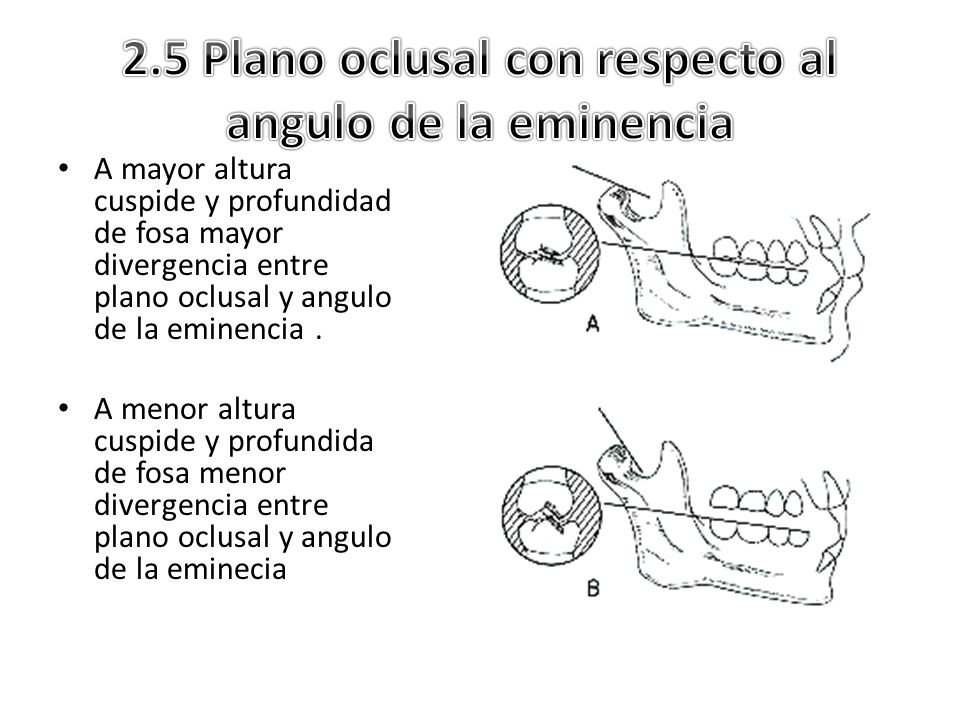 2.5 Plano oclusal con respecto al angulo de la eminencia