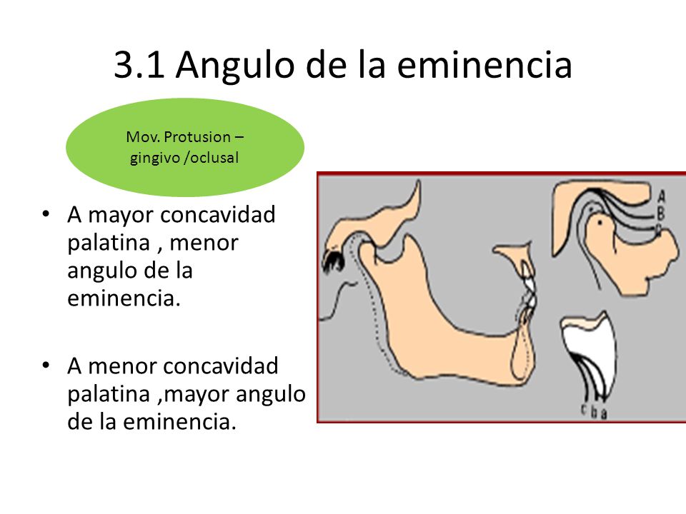 Mov. Protusion –gingivo /oclusal