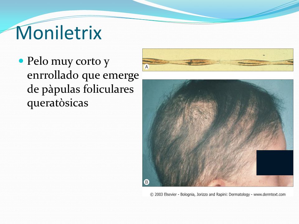 Moniletrix Pelo muy corto y enrrollado que emerge de pàpulas foliculares queratòsicas