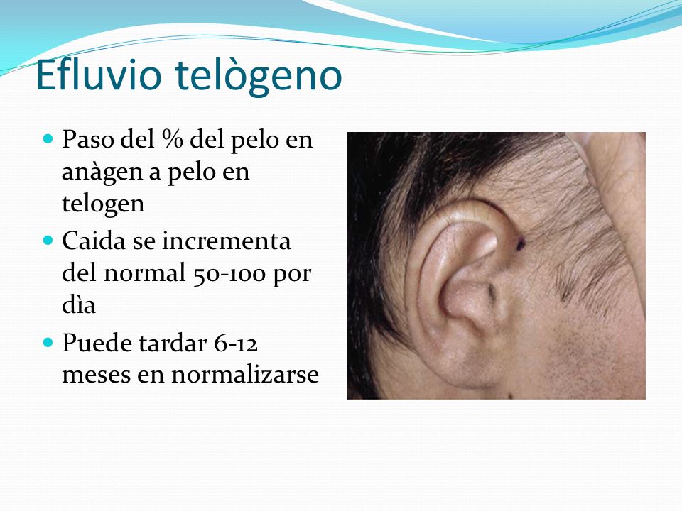 Efluvio telògeno Paso del % del pelo en anàgen a pelo en telogen