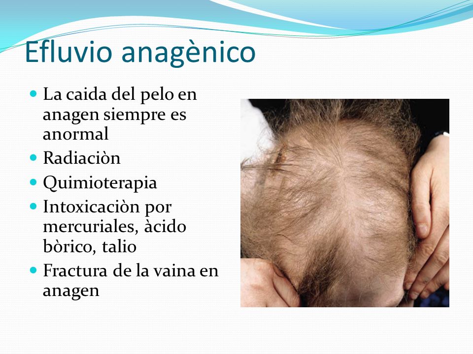 Efluvio anagènico La caida del pelo en anagen siempre es anormal