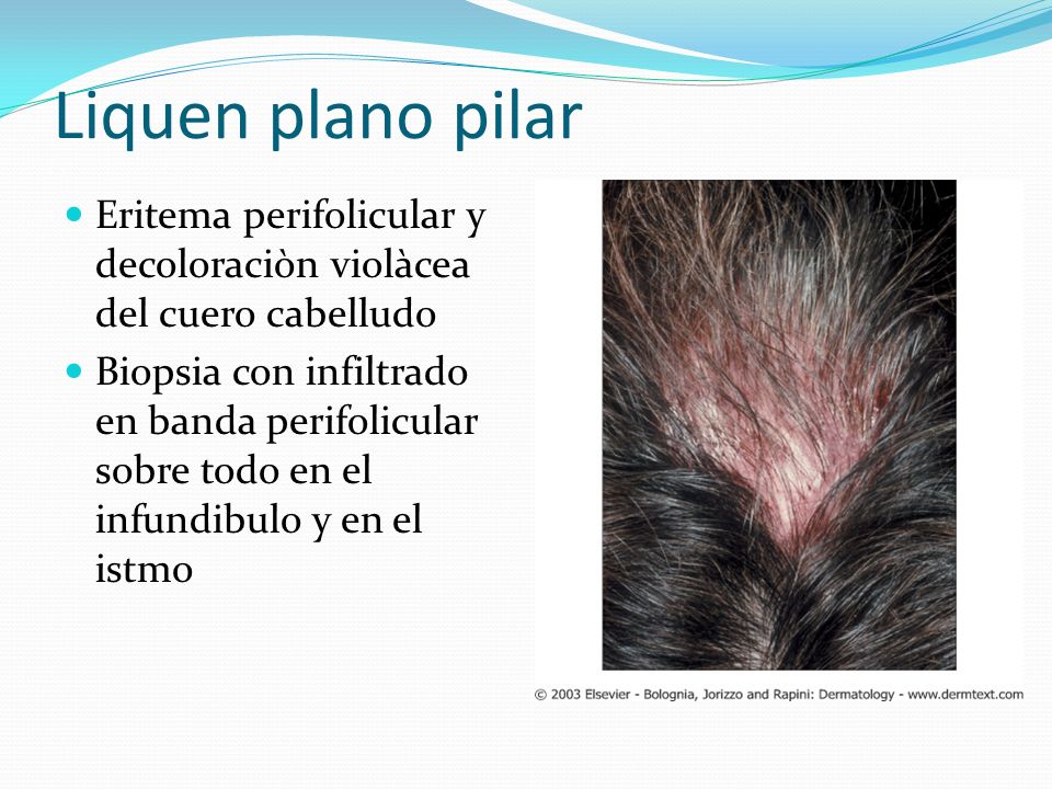 Liquen plano pilar Eritema perifolicular y decoloraciòn violàcea del cuero cabelludo.