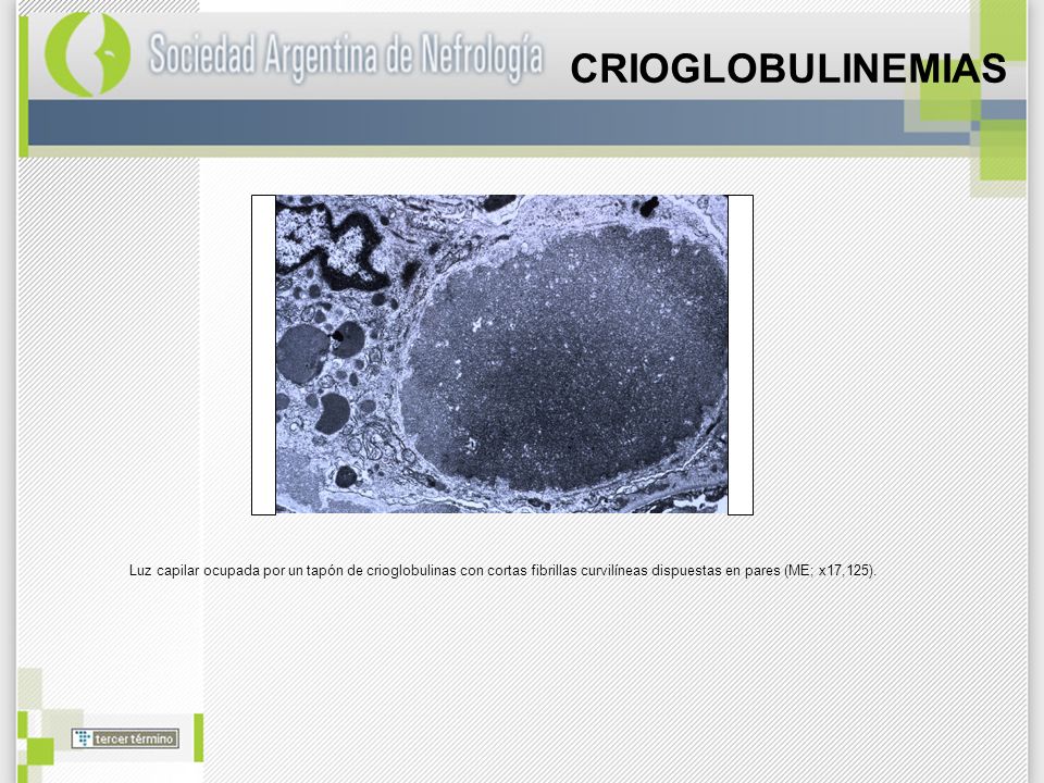 CRIOGLOBULINEMIAS Luz capilar ocupada por un tapón de crioglobulinas con cortas fibrillas curvilíneas dispuestas en pares (ME; x17,125).