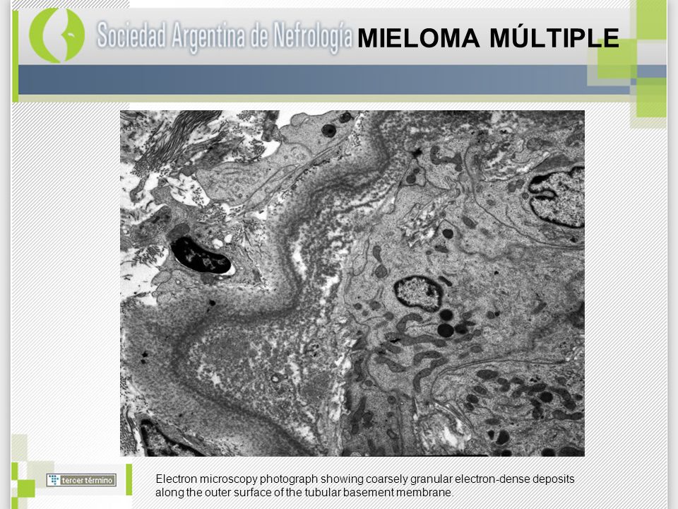 MIELOMA MÚLTIPLE Electron microscopy photograph showing coarsely granular electron-dense deposits.