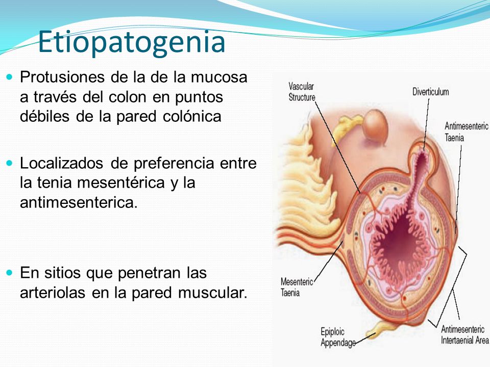 Etiopatogenia Protusiones de la de la mucosa a través del colon en puntos débiles de la pared colónica.