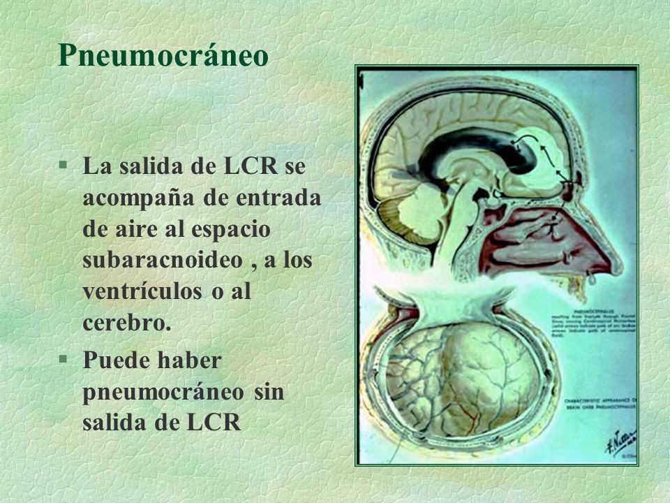 Pneumocráneo La salida de LCR se acompaña de entrada de aire al espacio subaracnoideo , a los ventrículos o al cerebro.
