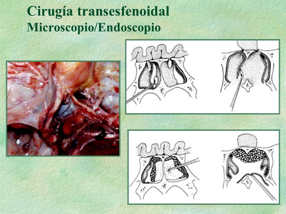 Cirugía transesfenoidal Microscopio/Endoscopio