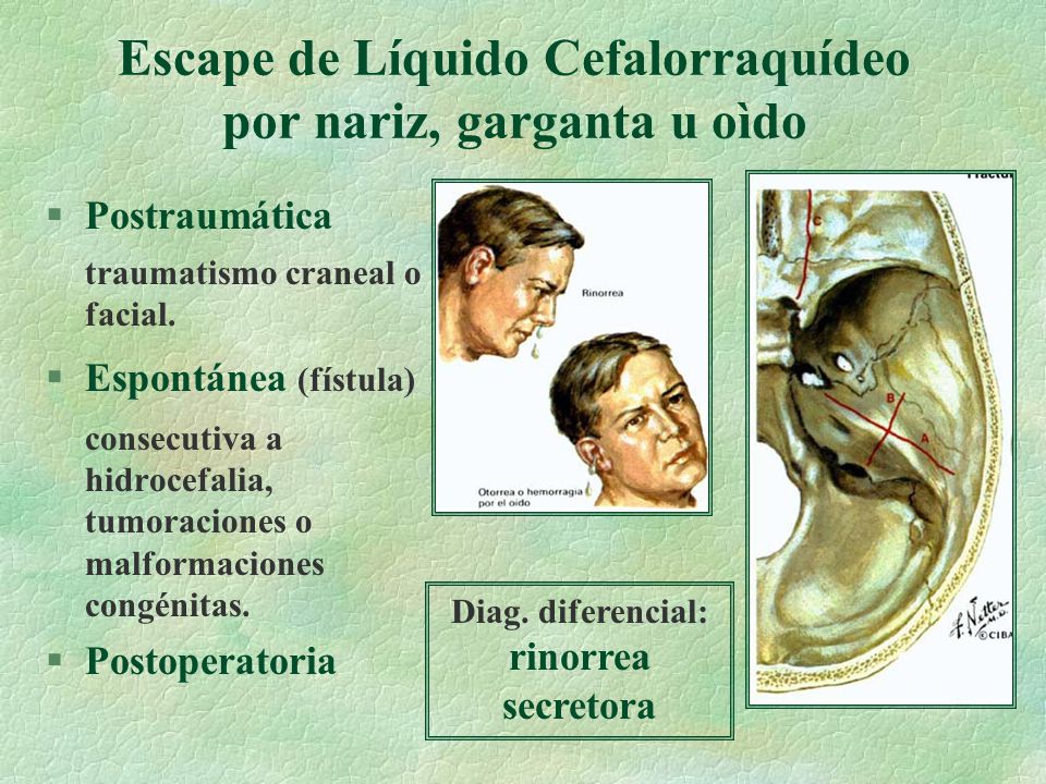 Escape de Líquido Cefalorraquídeo por nariz, garganta u oìdo