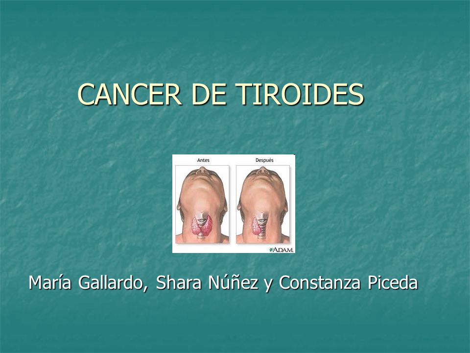 CANCER DE TIROIDES María Gallardo, Shara Núñez y Constanza Piceda