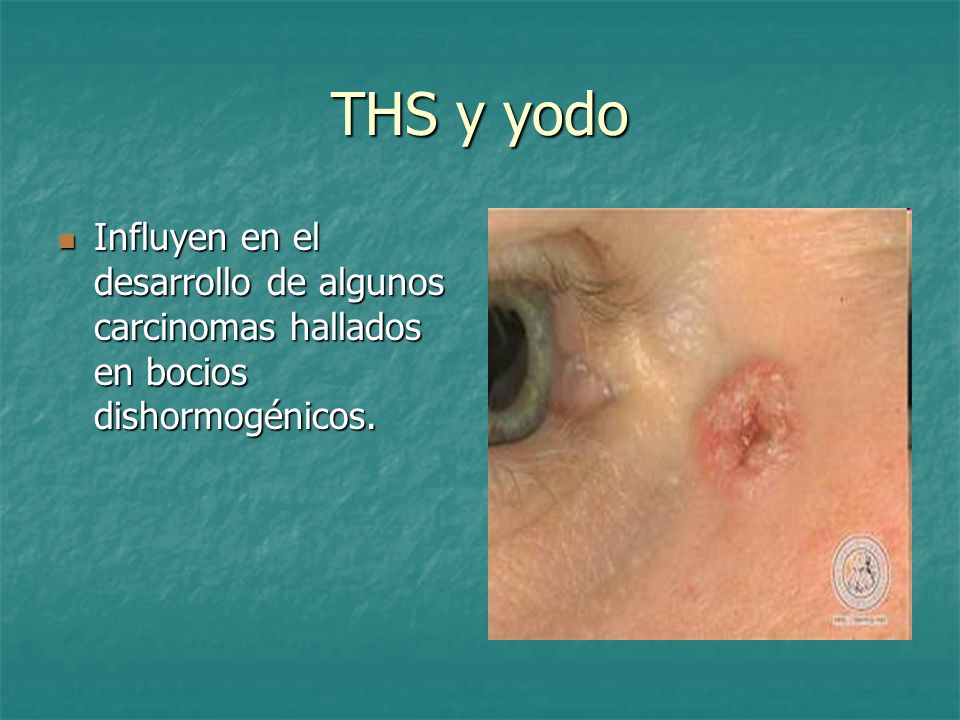 THS y yodo Influyen en el desarrollo de algunos carcinomas hallados en bocios dishormogénicos.