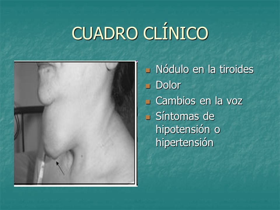 CUADRO CLÍNICO Nódulo en la tiroides Dolor Cambios en la voz