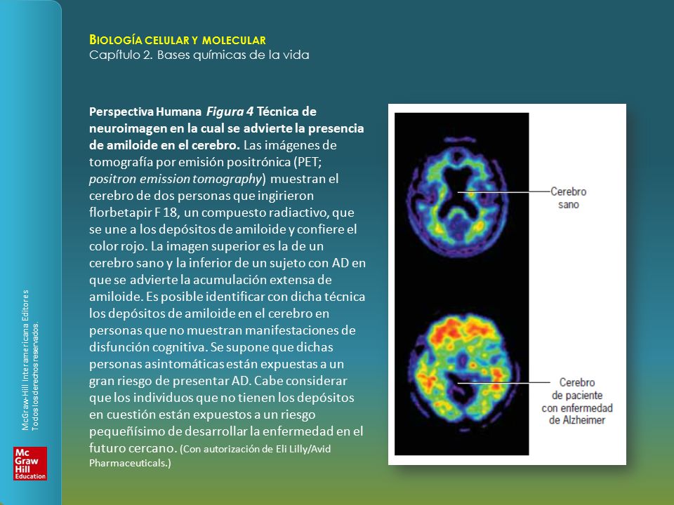 Perspectiva Humana Figura 4 Técnica de neuroimagen en la cual se advierte la presencia de amiloide en el cerebro.