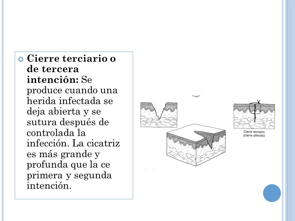 Cierre terciario o de tercera intención: Se produce cuando una herida infectada se deja abierta y se sutura después de controlada la infección.
