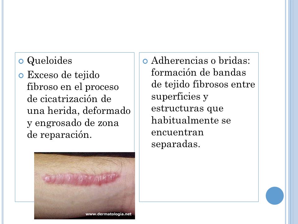 Queloides Exceso de tejido fibroso en el proceso de cicatrización de una herida, deformado y engrosado de zona de reparación.