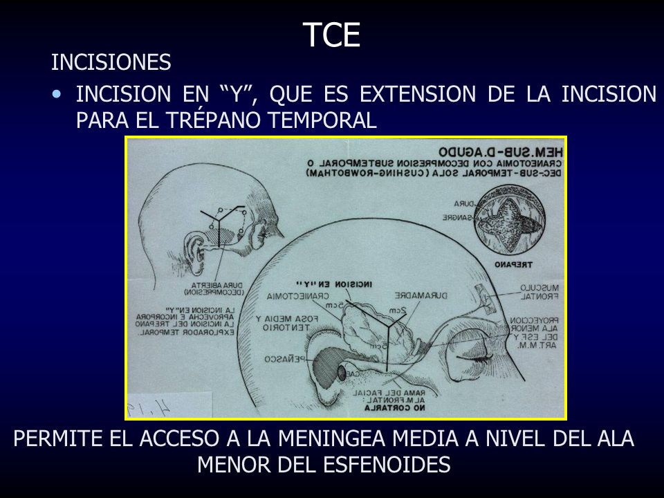 TCE INCISIONES. INCISION EN Y , QUE ES EXTENSION DE LA INCISION PARA EL TRÉPANO TEMPORAL.