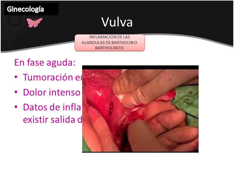 INFLAMACION DE LAS GLANDULAS DE BARTHOLIN O BARTHOLINITIS